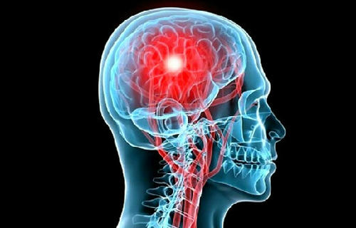 人体羊膜细胞或可用于中风治疗